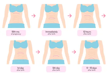 Infographics about post-baby belly
